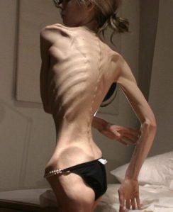 yvonnelin_Anorexia